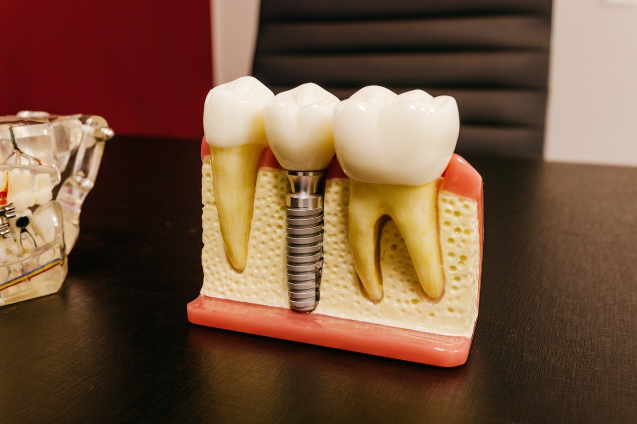All-on-4 Teeth Implants